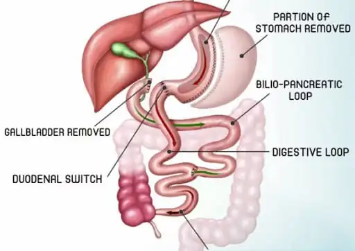 duodenal switch