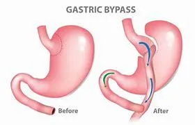 Gastric bypass voor en na