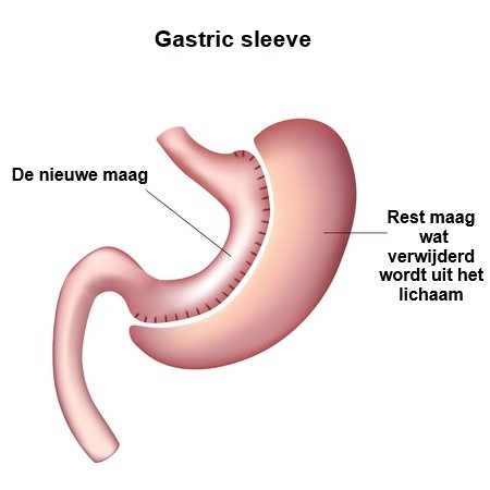 Gastric sleeve